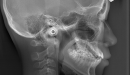 矯正用レントゲン